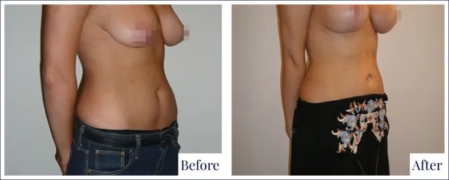 Breast Lift Surgery Result