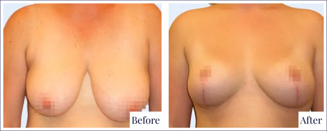 Breast Lift Surgery Result