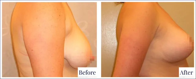 Breast Lift Plastic Surgery Result