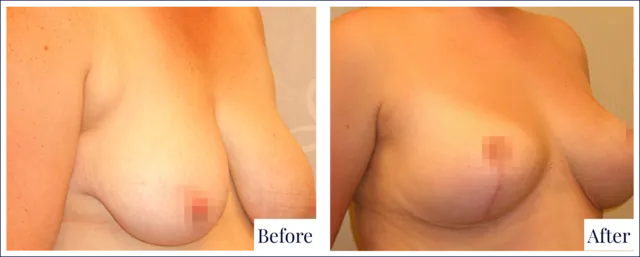 Breast Lift Cosmetic Surgery Result