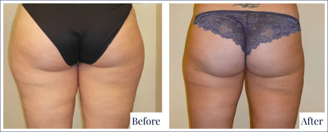 Liposuction Surgery Result