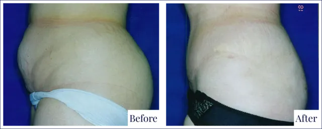 Liposuction Surgery Before & After Image