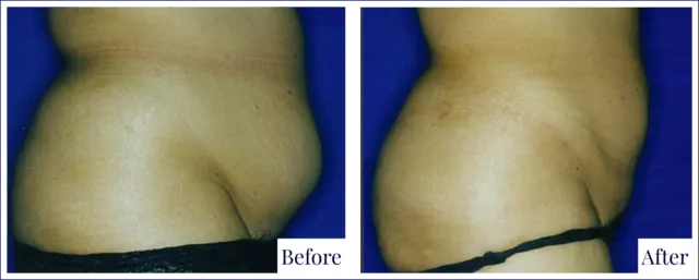 Liposuction Surgery Before & After Photo