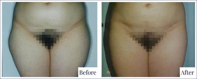 Liposuction Result