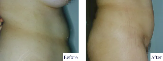 Body Procedure Before & After Photo