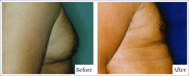 Male Breast Surgery Result