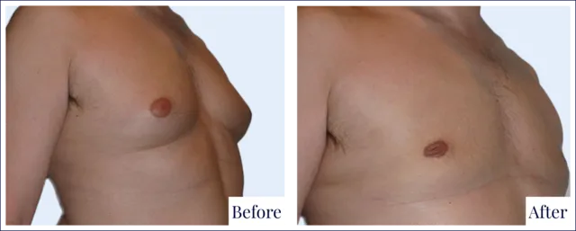 Male Breast Surgery Before & After Photo