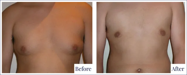 Male Breast Surgery Before & After Image
