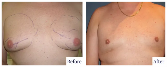 Gynecomastia Surgery Before & After Photo