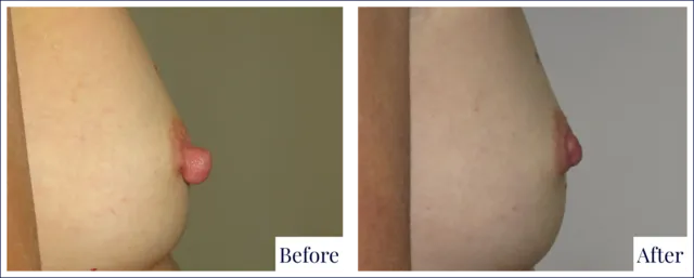 Nipple Reduction Before & After Photo