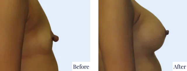 Nipple Reduction Result