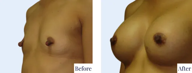 Nipple Reduction Surgery Result