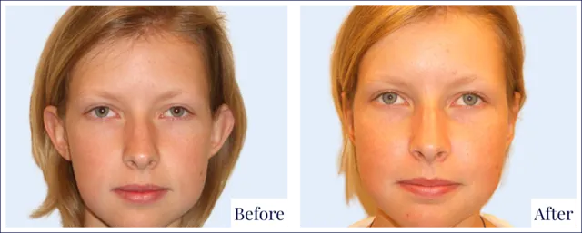 Otoplasty Surgery Before & After Photo