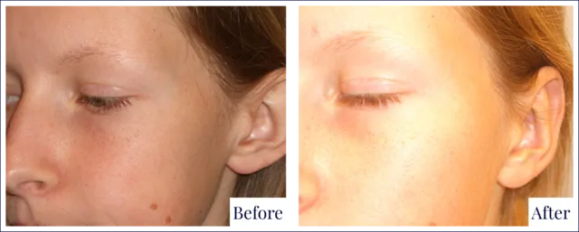 Ear Cosmetic Surgery Before & After Image