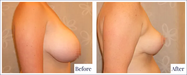 Breast Reduction Before & After Photo