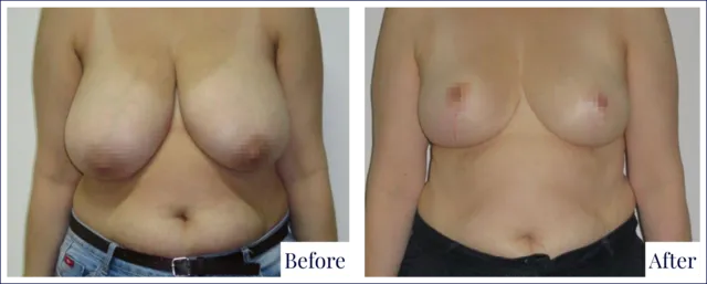 Breast Reduction Before & After Result