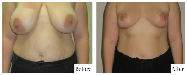Breast Reduction Result