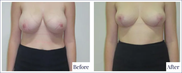 Breast Reduction Surgery Before & After Image