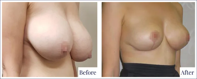 Breast Reduction Surgery Result