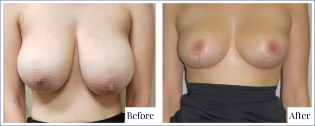 Breast Reduction Treatment Before & After Photo