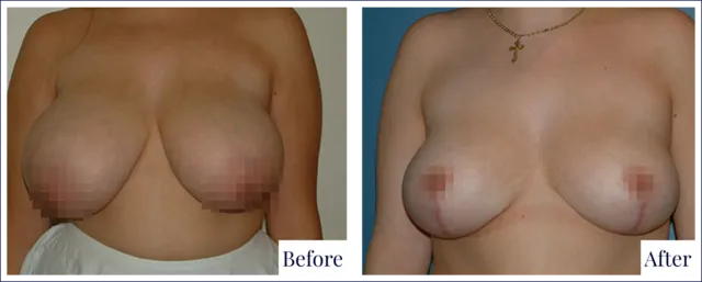 Breast Reduction Treatment Before & After Image