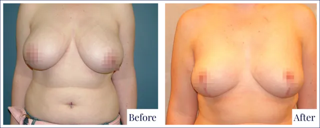 Breast Reduction Treatment Before & After Result