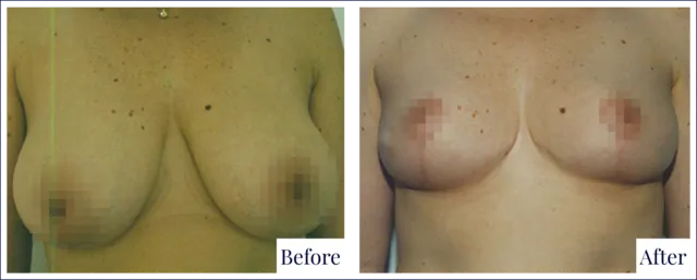 Breast Reduction Treatment Result