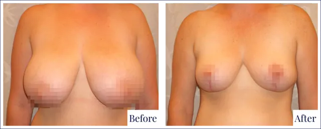 Breast Reduction Before & After Result