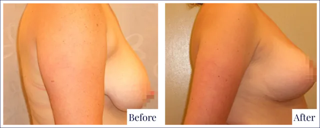 Breast Reduction Result