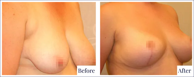 Breast Reduction Surgery Before & After Photo