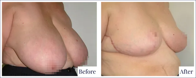 Breast Reduction Surgery Before & After Result