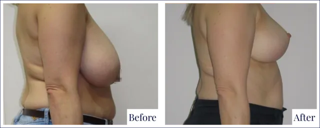 Breast Reduction Surgery Result