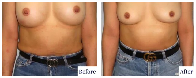 Breast Revision Surgery Before & After Photo