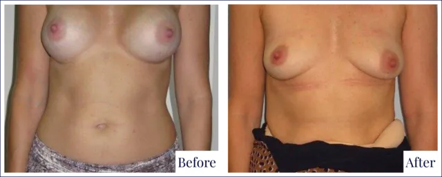 Breast Revision Surgery Result