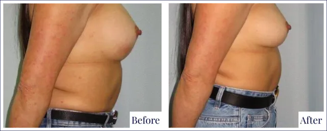 Breast Revision Before & After Photo