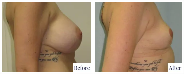 Breast Revision Before & After Photo