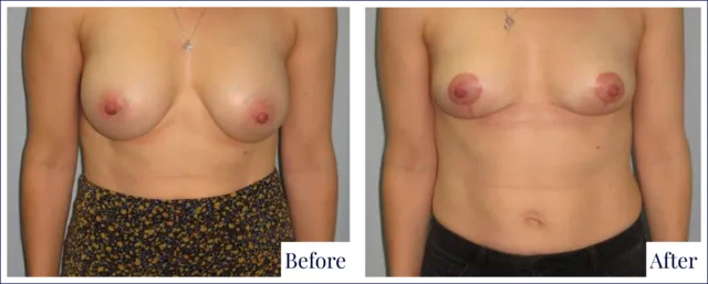 Breast Revision Surgery Before & After Photo