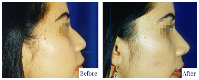Rhinoplasty Surgery Before & After Image
