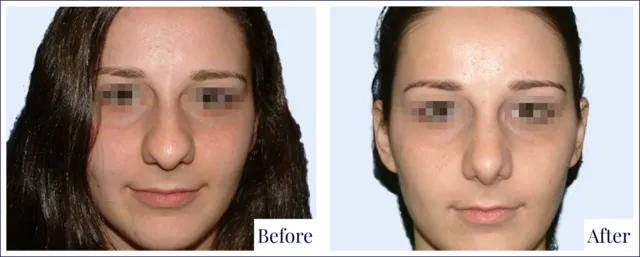 Rhinoplasty Surgery Before & After Image