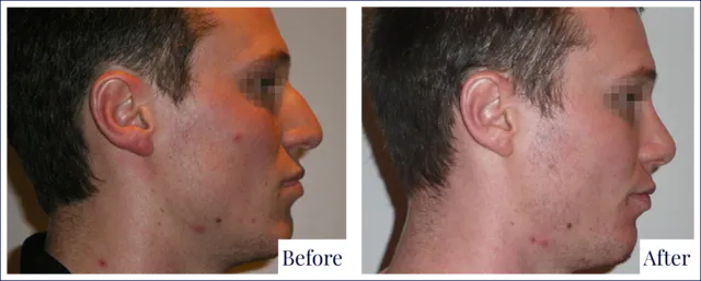 Nose Surgery Before & After Photo