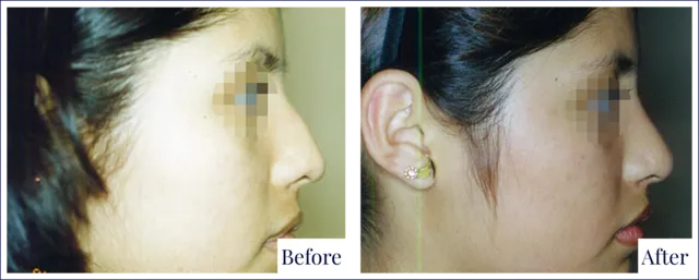 Rhinoplasty Surgery Before & After Photo