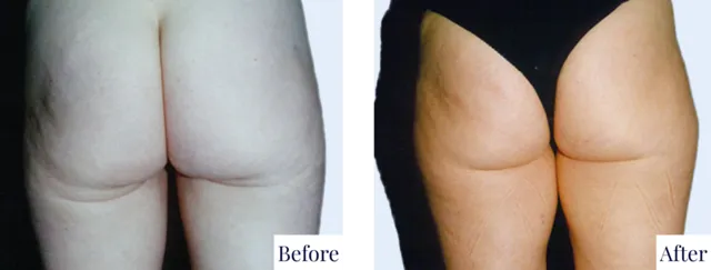 Thigh Lift Surgery Before & After Photo