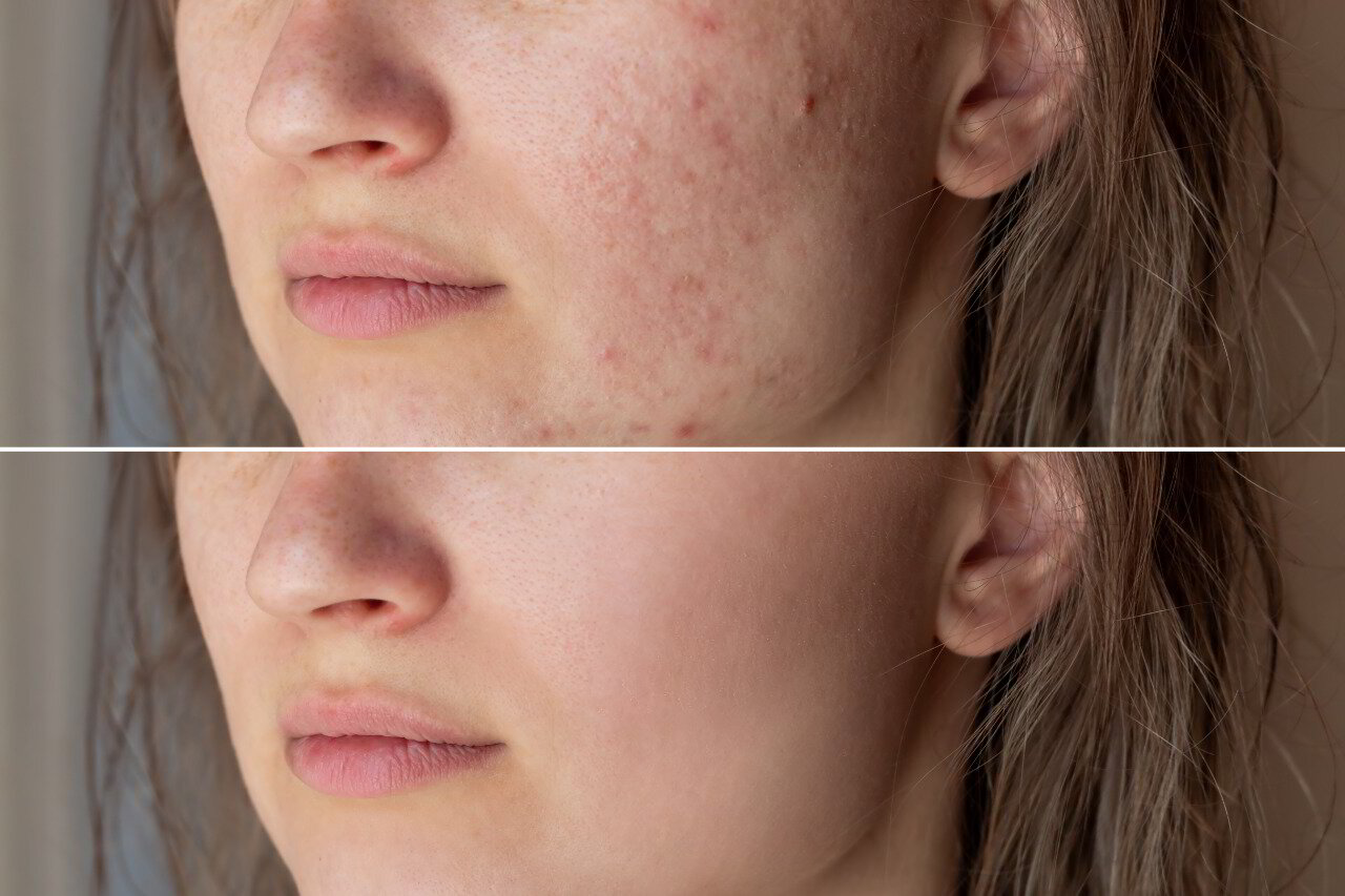 Best Acne Scar Removal Treatment in Hyderabad Evoluer Aesthetics