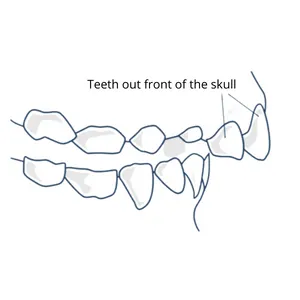Upper Front Teeth Protrusion/Overbite