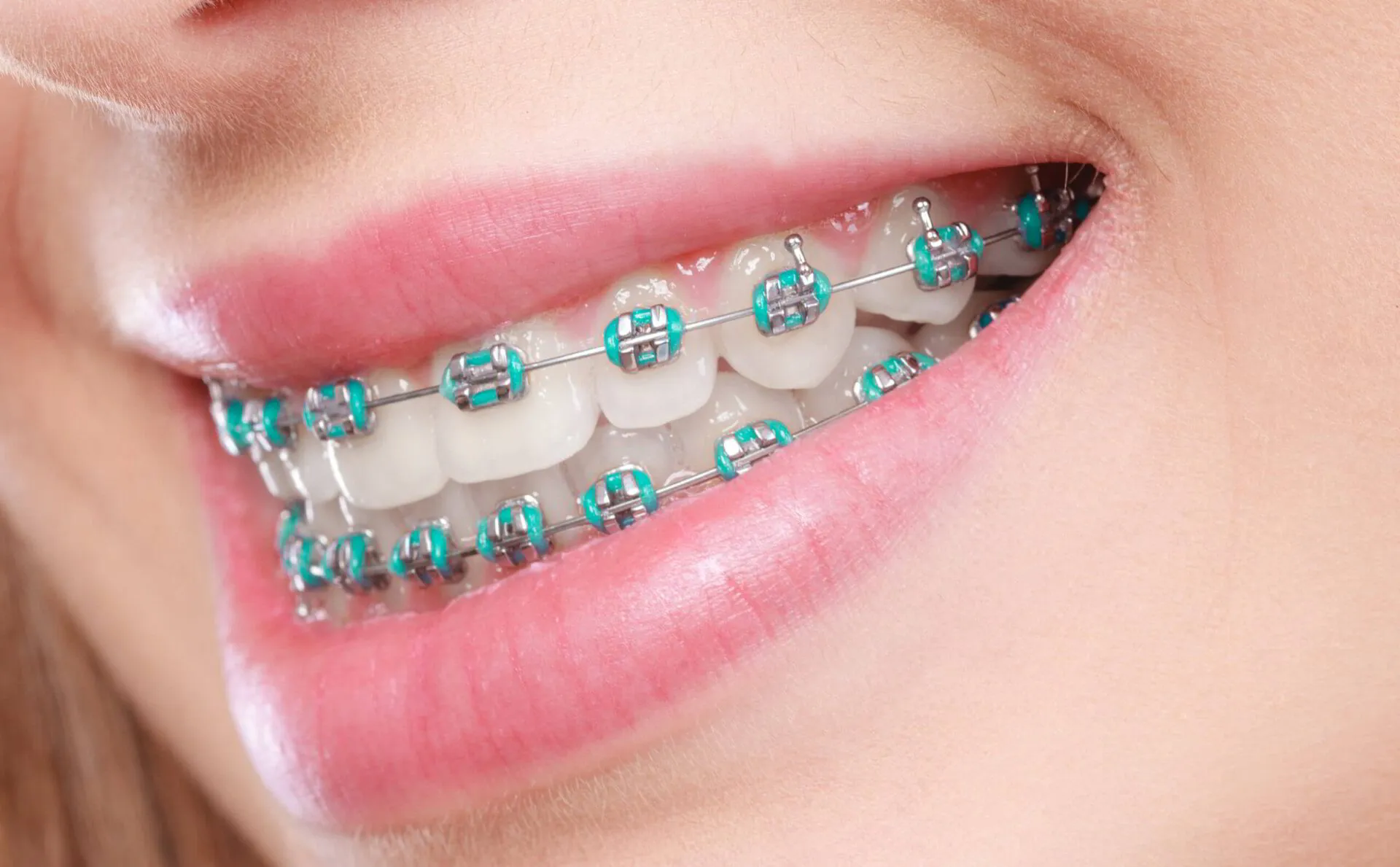 Best Clear Braces: Invisible Solutions for Adults