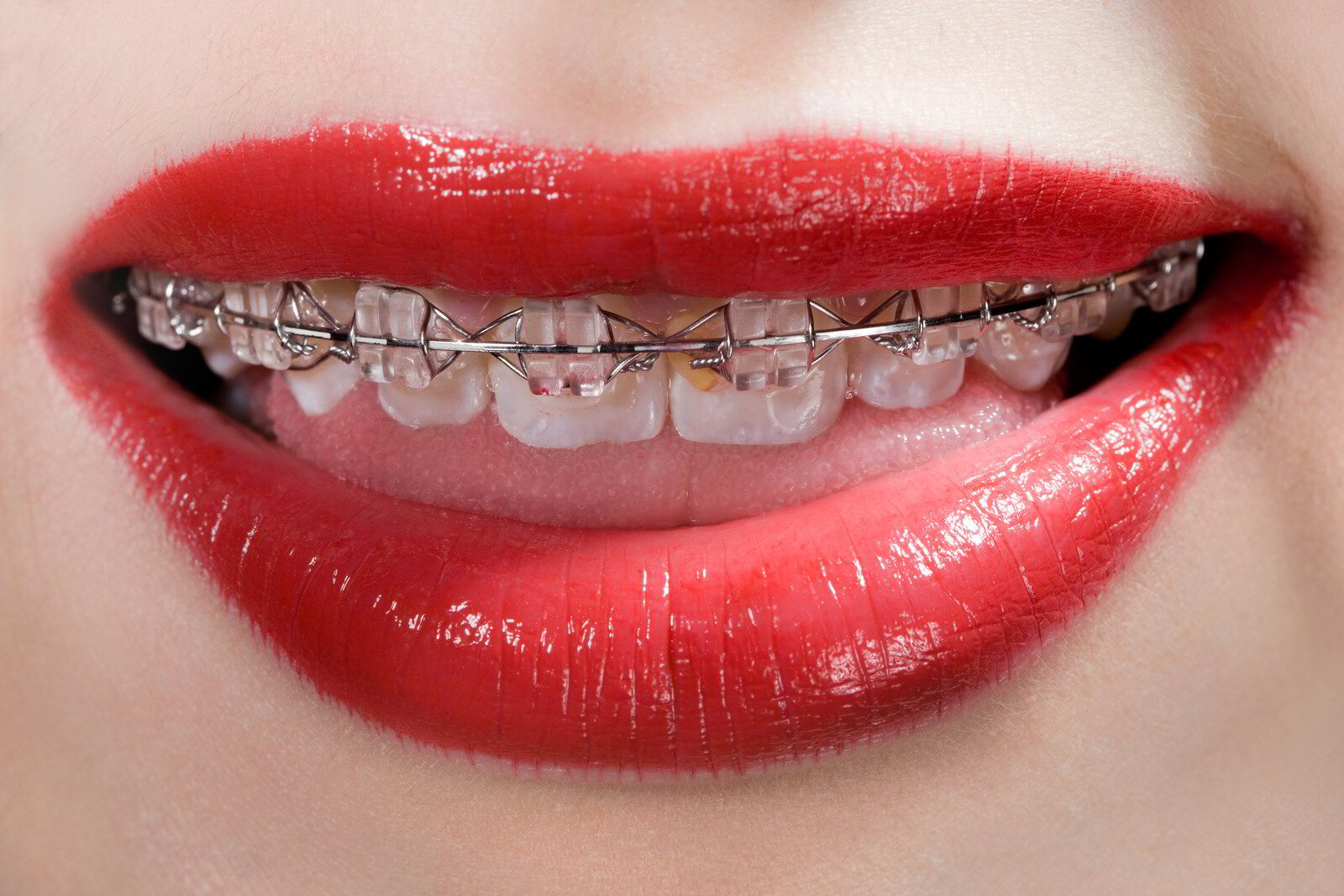 What Do Orthodontic Services Include? | Bartlettortho