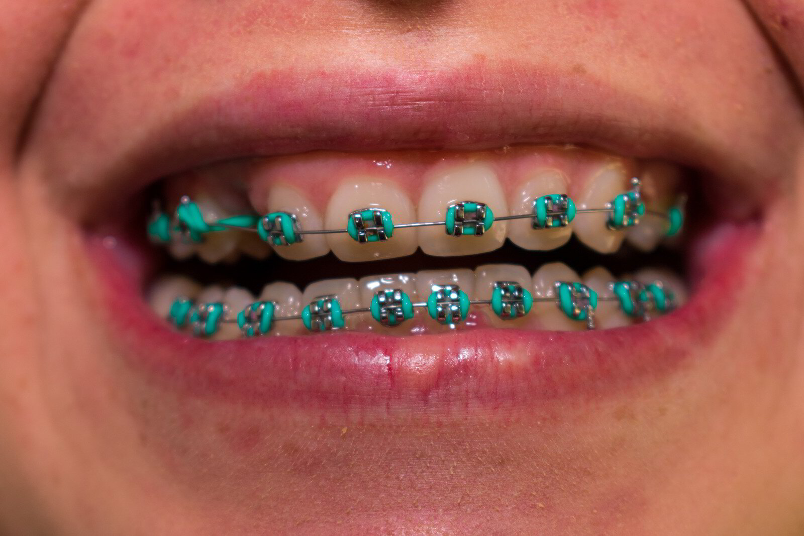 Why Orthodontic Treatment Is Important For Adults