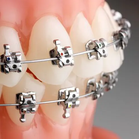 DentalBraces_QuestDental