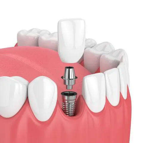 dental implant_questdental