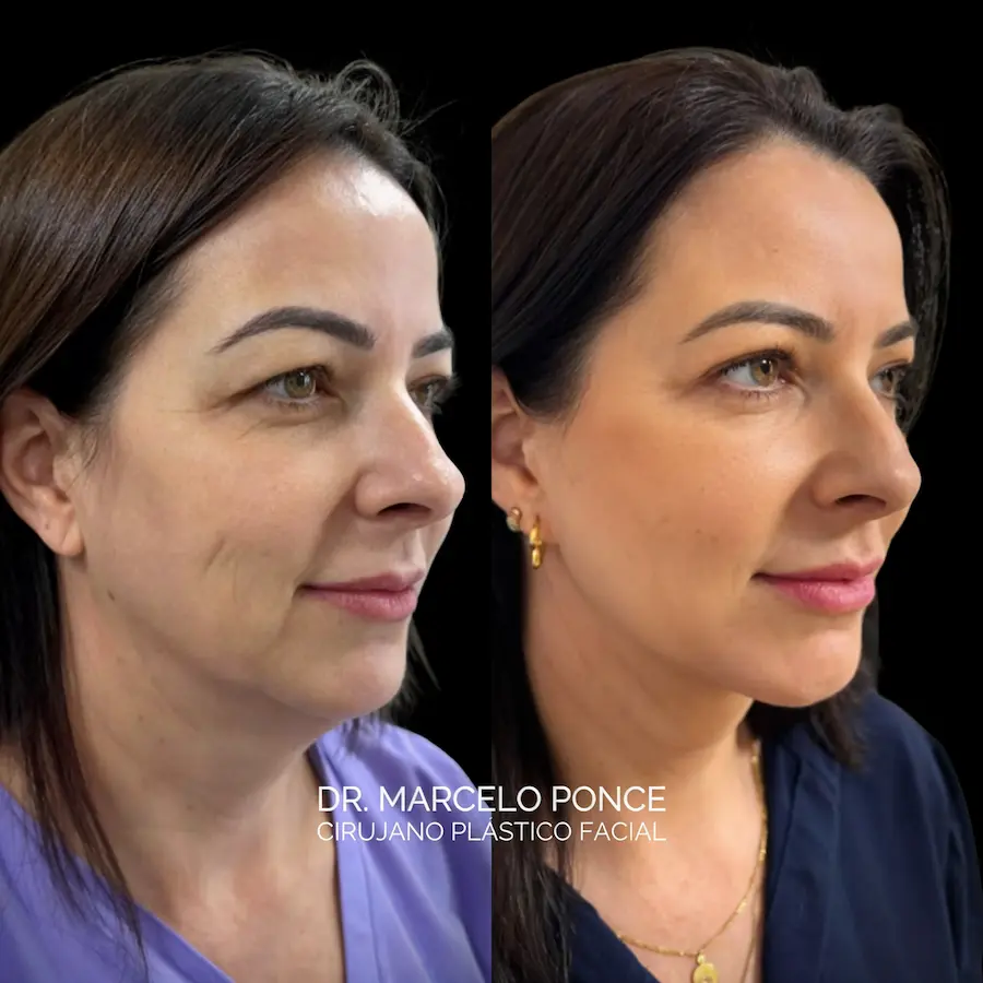Lifting Facial Deep Plane En Guayaquil lifting-facial-deep-plane-en-guayaquil